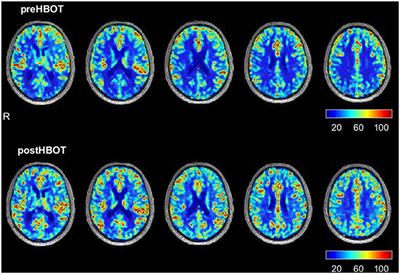 The effect of hyperbaric oxygen therapy on cognition, performance, proteomics, and telomere length—The difference between zero and one: A case report